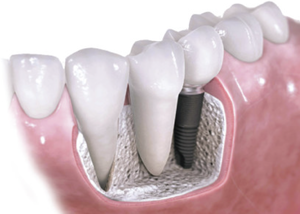 Imagen de Implantes Tradicionales
