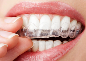 Imagen de Retenedores